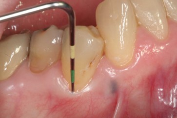 دراسة طبية: التهابات الأسنان تفاقم الإصابة بأمراض القلب