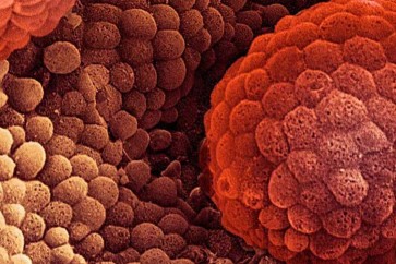 الكشف المبكر عن سرطان القولون والمستقيم في سن الـ45 عاما… يقلل من الوفيات