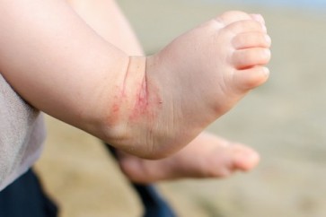 المرطبات قد لا تخفف أعراض الإكزيما لدى الأطفال