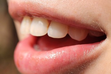 علاج جديد يقضي على تسوس الأسنان