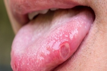 Tongue Cancer